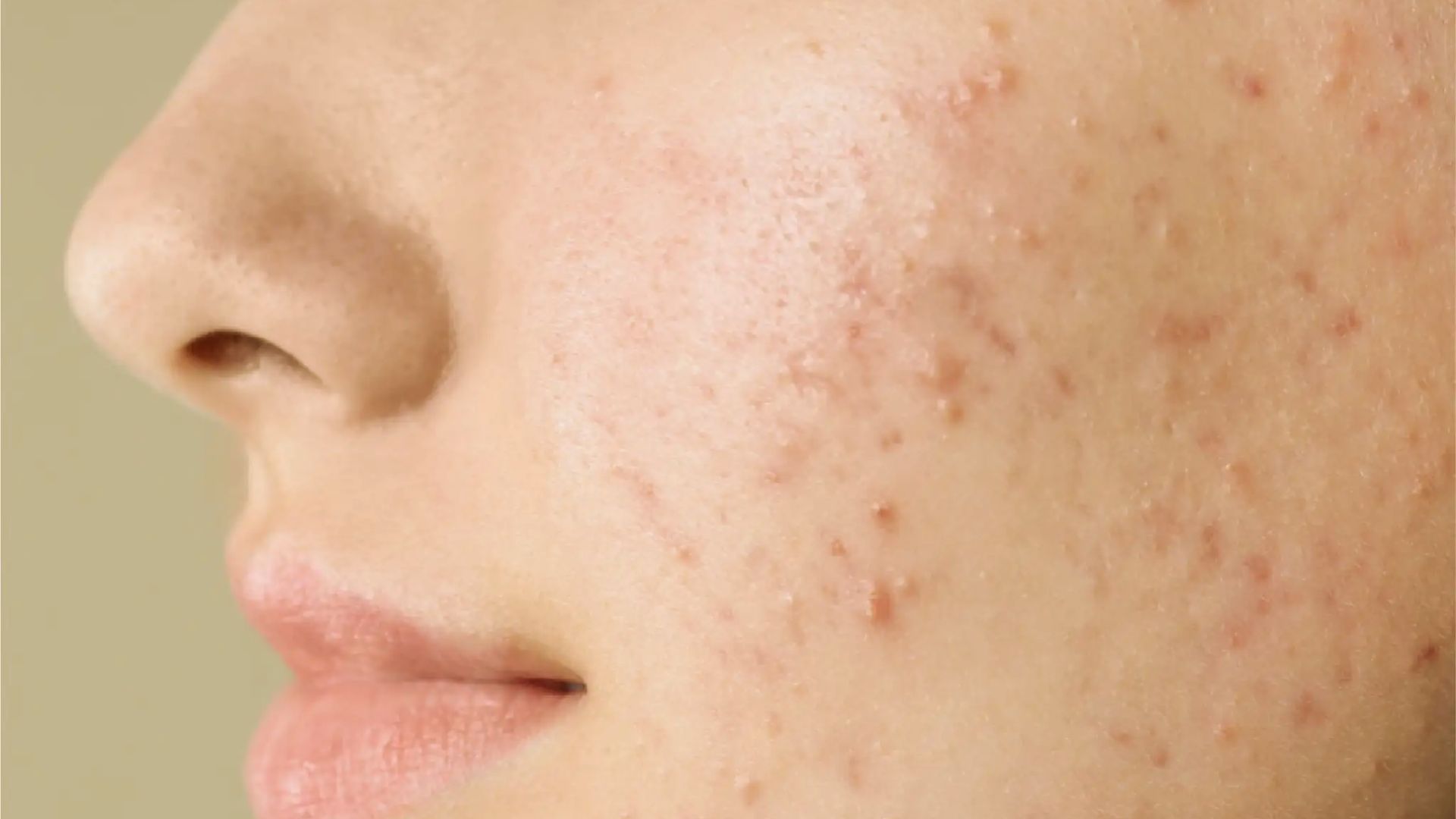 The image shows red facial bumps, highlighting acne, a widespread skin condition.