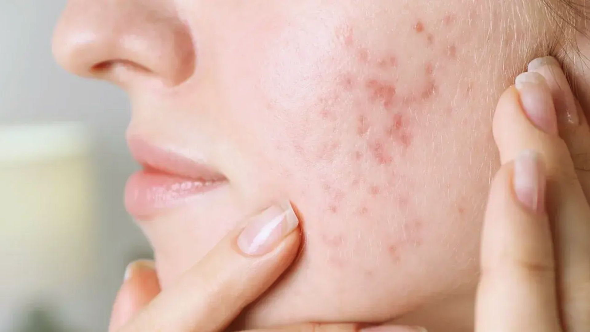 Women's acne treatment options displayed, highlighting various skincare products aimed at reducing breakouts.