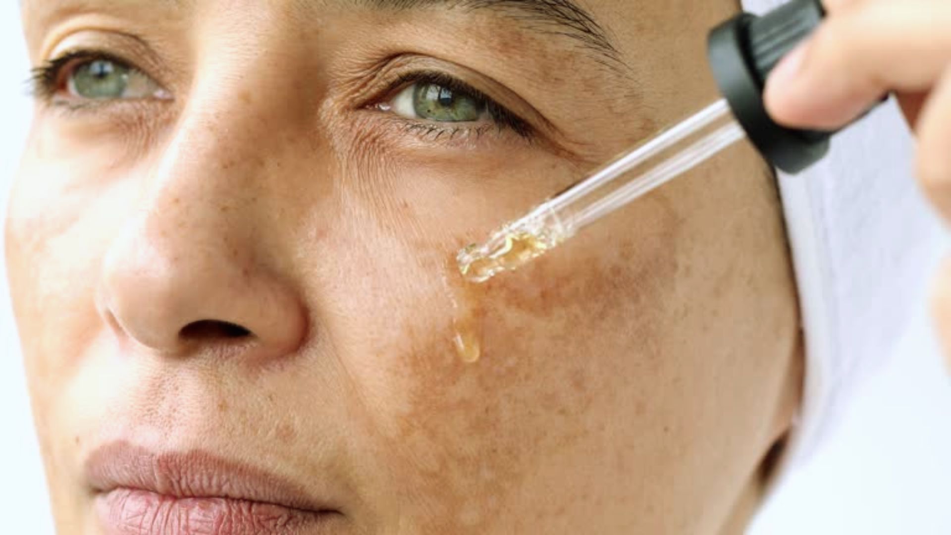 A woman with visible acne on her face, showcasing a range of skin textures and tones.