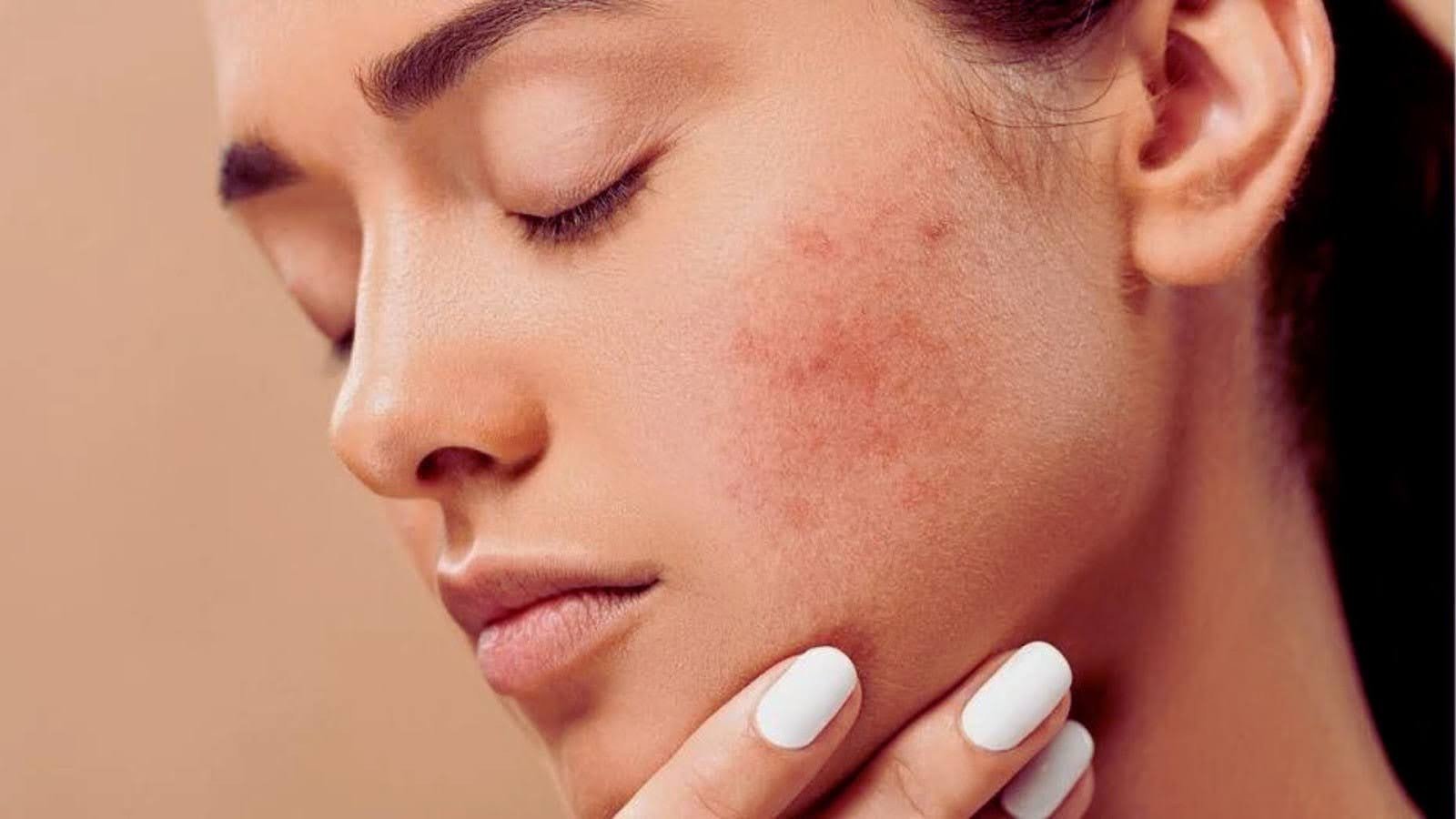 Diminishes Acne Scars and Stretch Marks