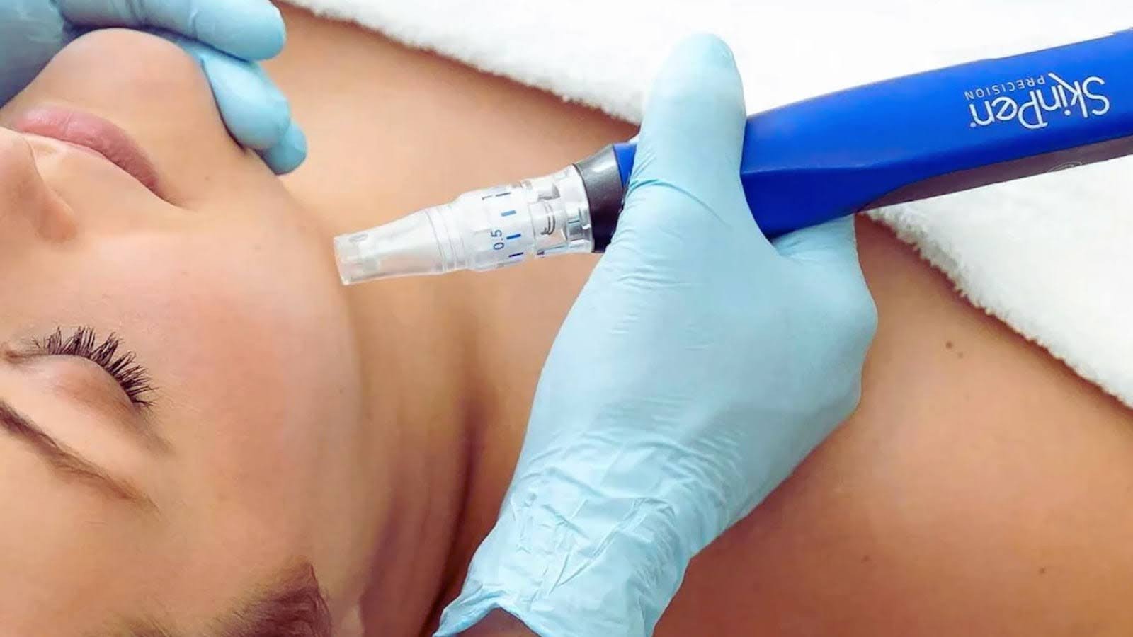 What is SkinPen Microneedling