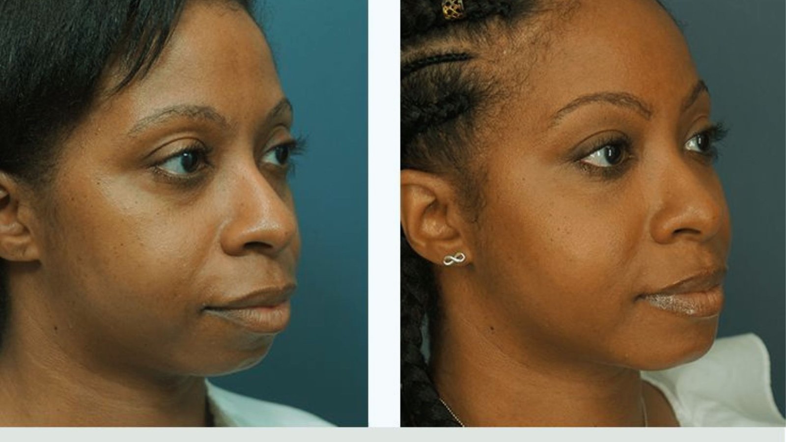 Facial Fat Transfer