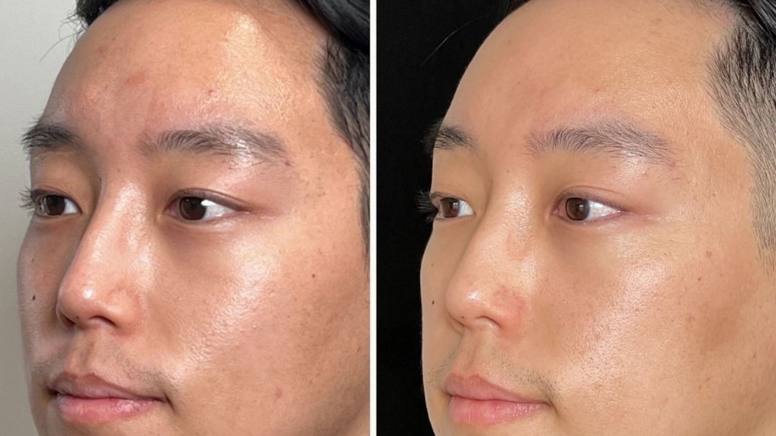 Microneedling with PRP