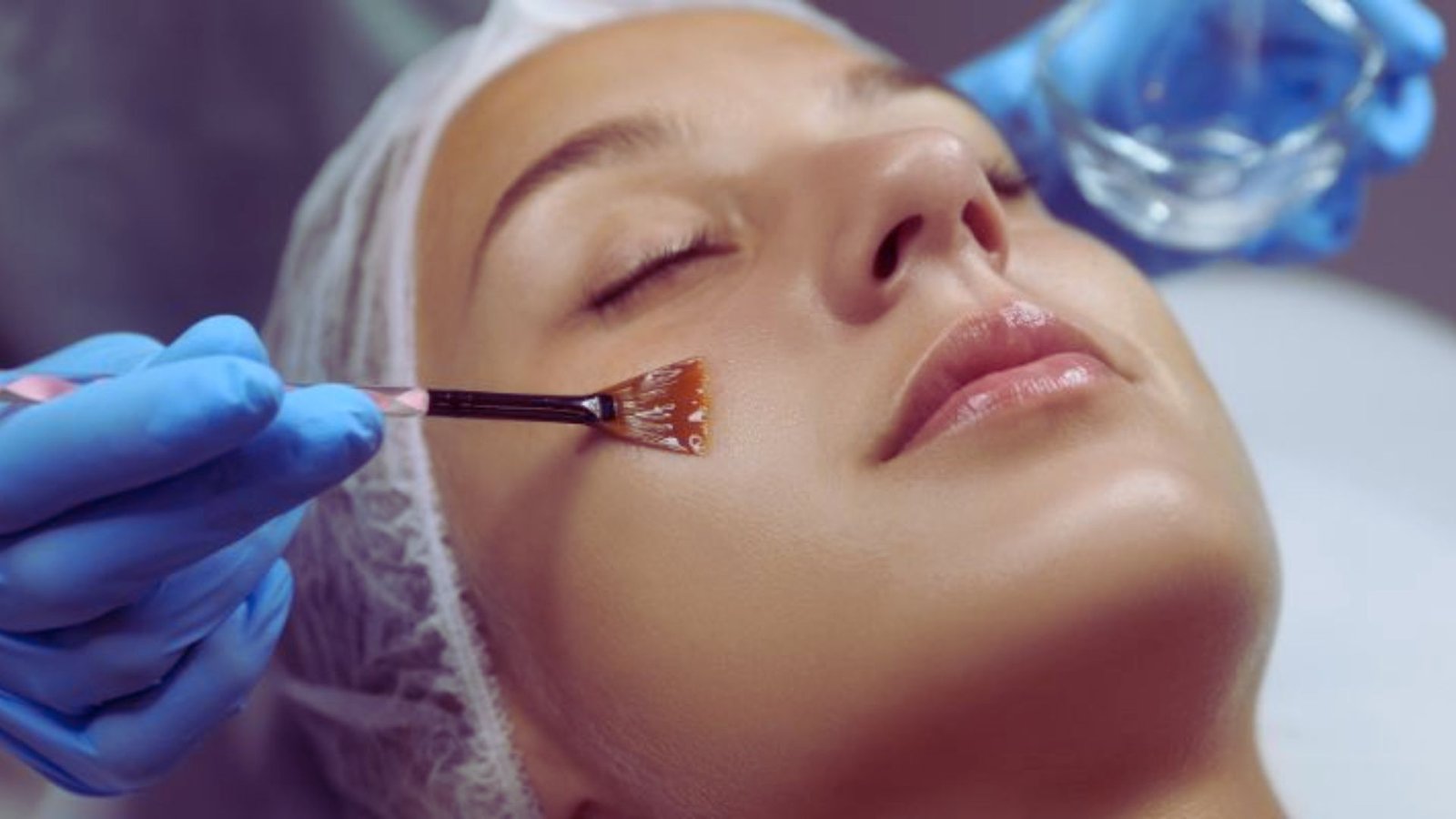 Chemical Peels