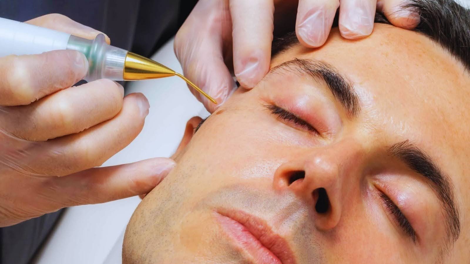 How a Mole Is Removed