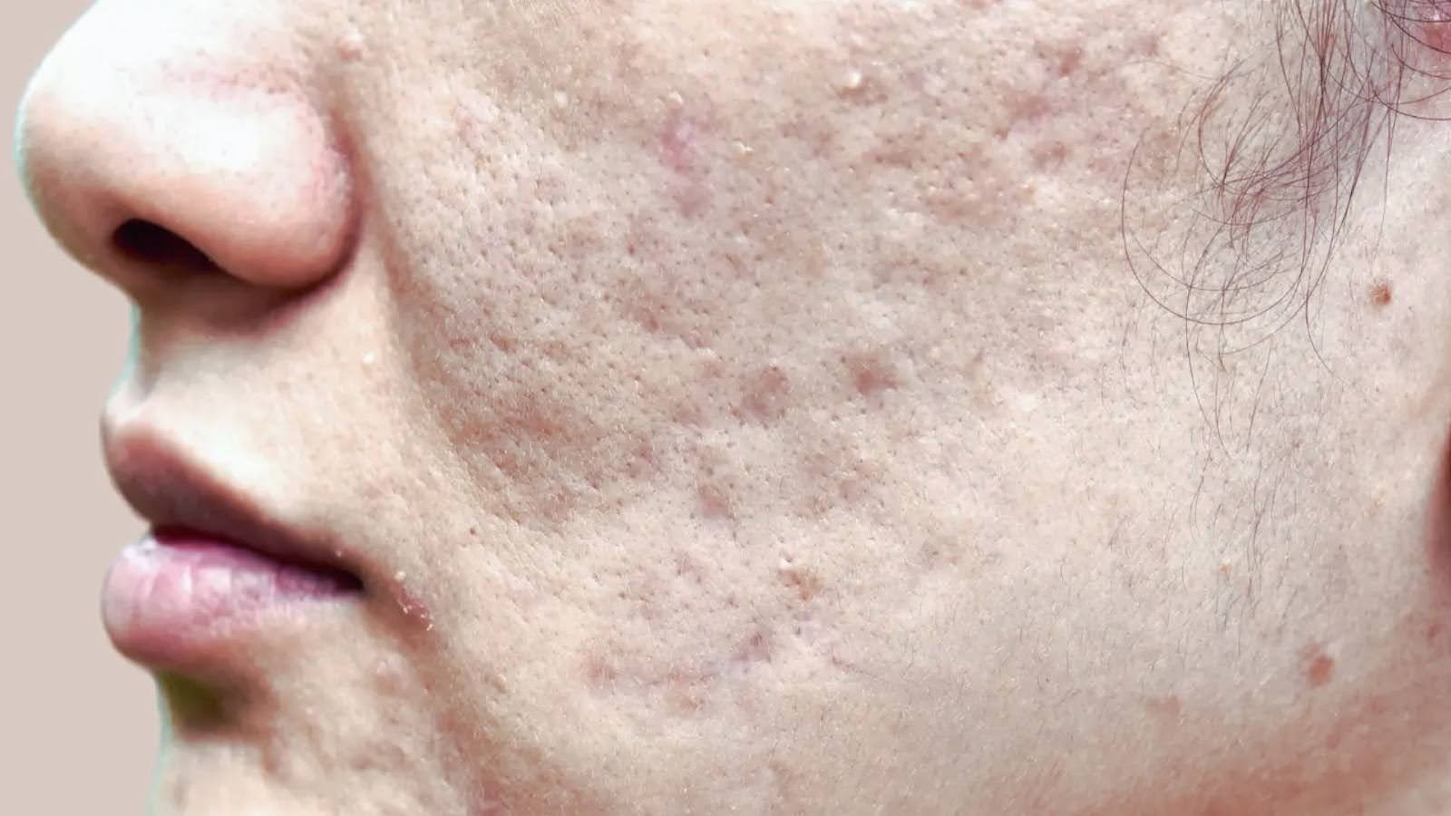 Misinterpretation of Purging vs Breakout