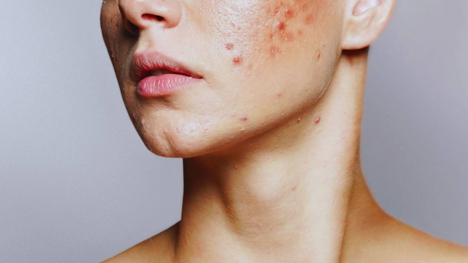 What is a Vitamin C Breakout