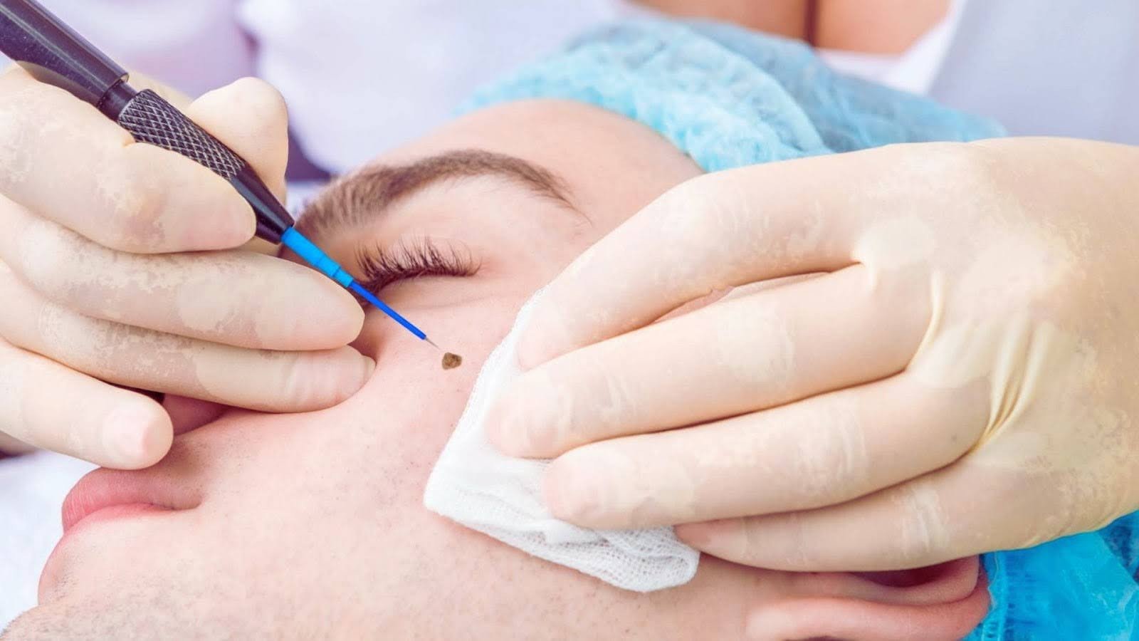 Why People Get Moles Removed