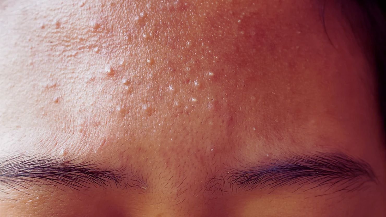 How to Identify Fungal Acne