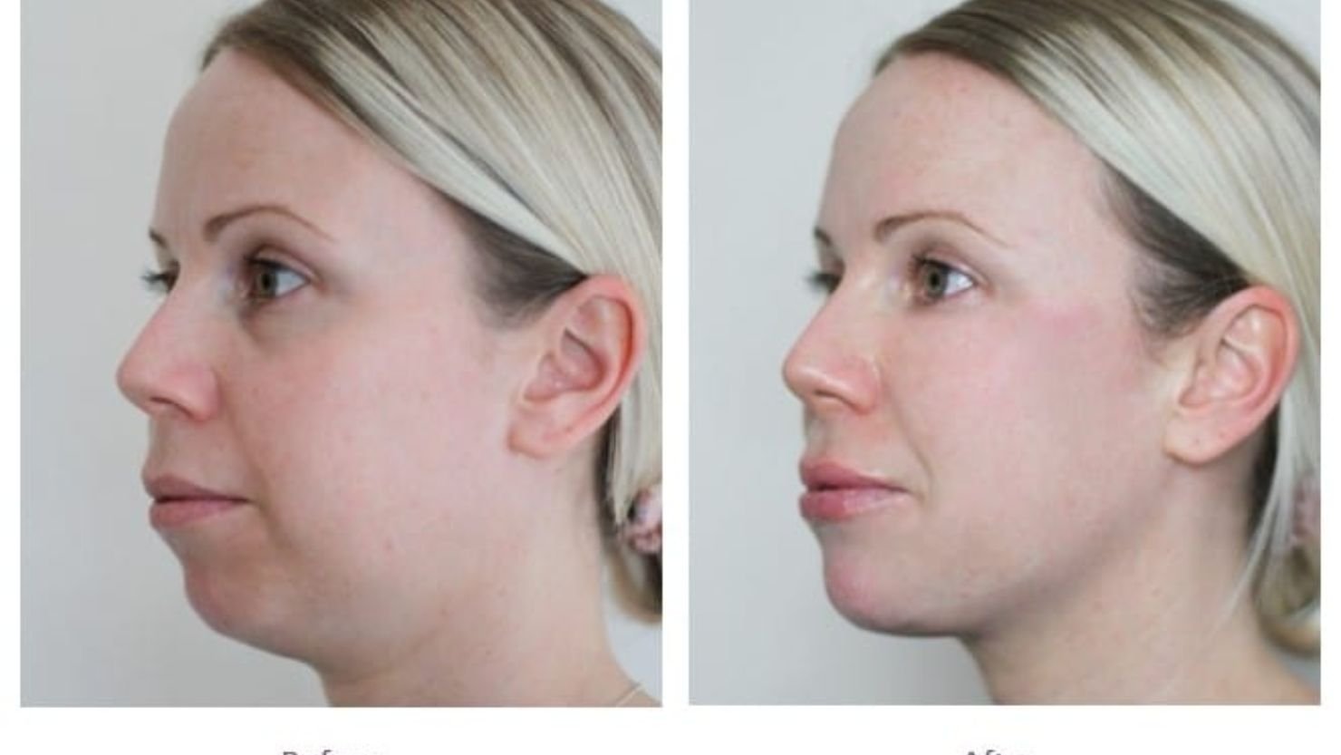 Dermal Fillers