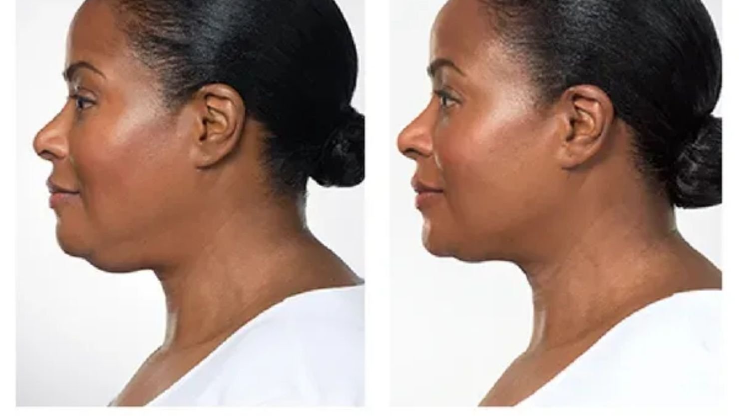 KYBELLA
