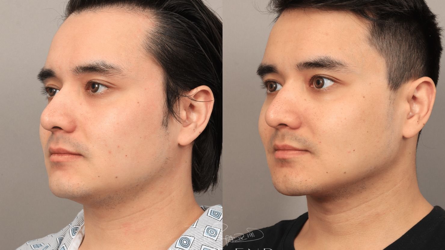 Facial Liposuction