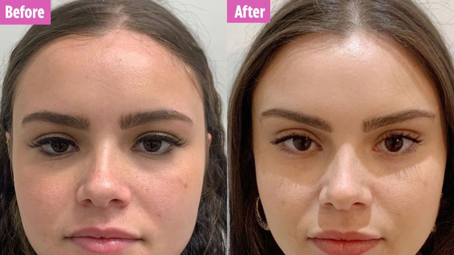 Is a PDO Thread Lift Right for You