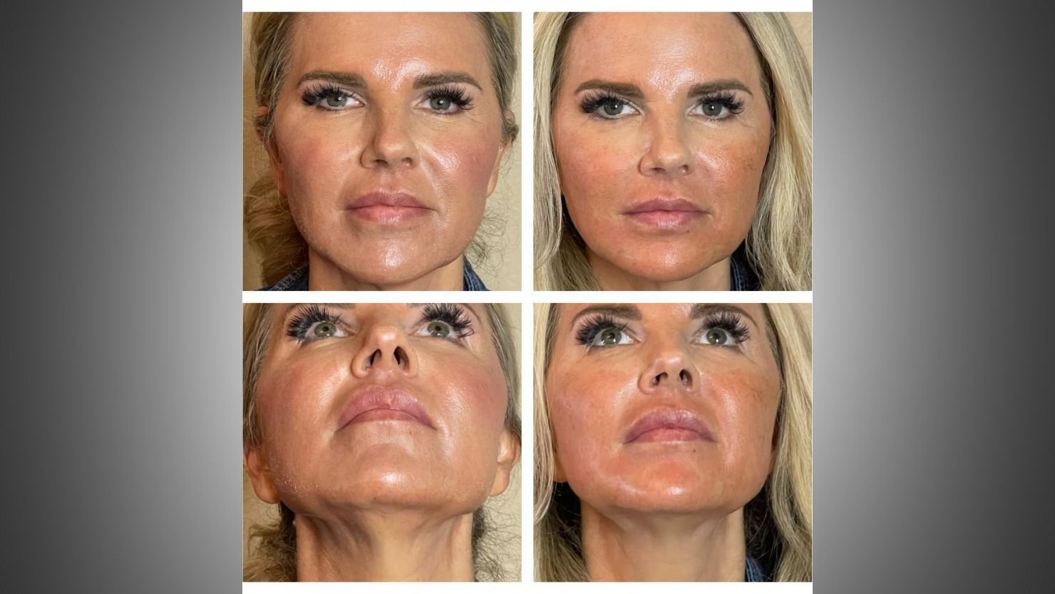 How PDO Thread Lifts Differ From Facelift Surgery