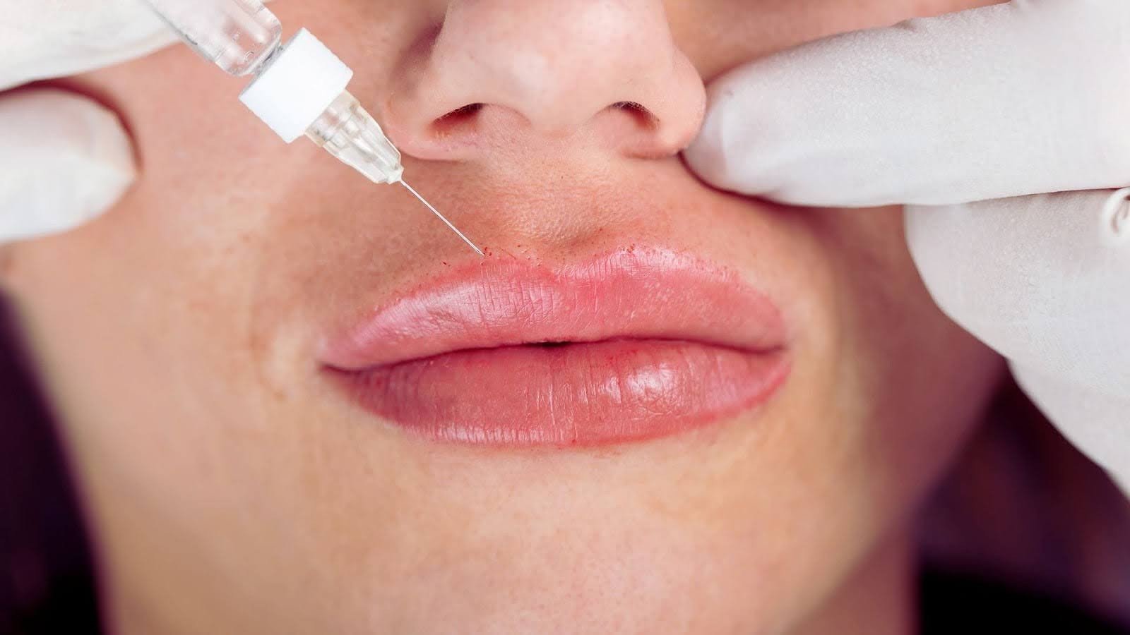 Typical Lip Filler Swelling Timeline