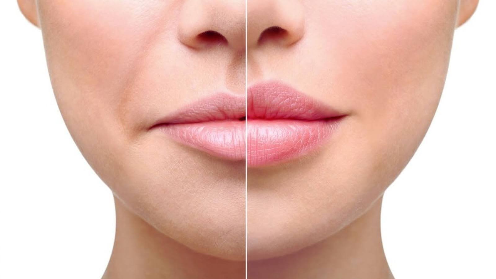 What Causes Lip Swelling After Filler