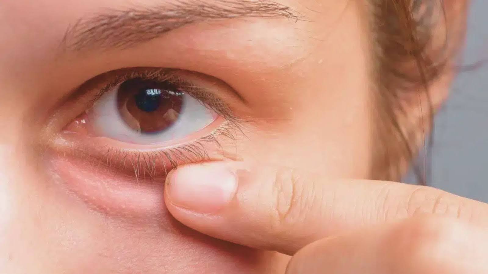 What Causes Under Eye Filler Migration