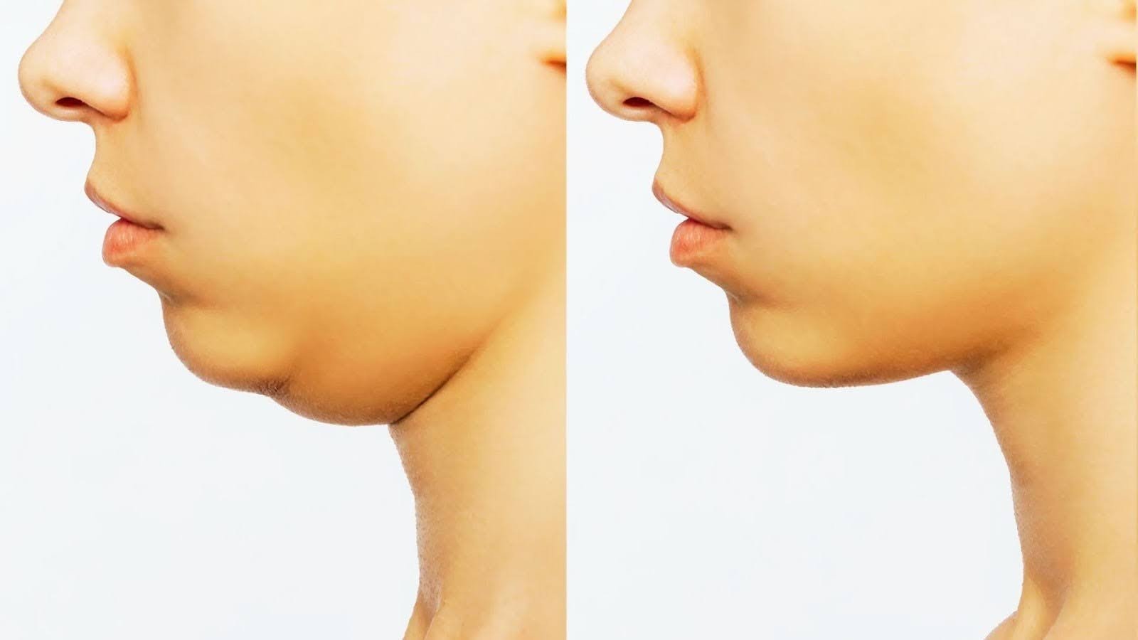 What Is Kybella and How Does It Work