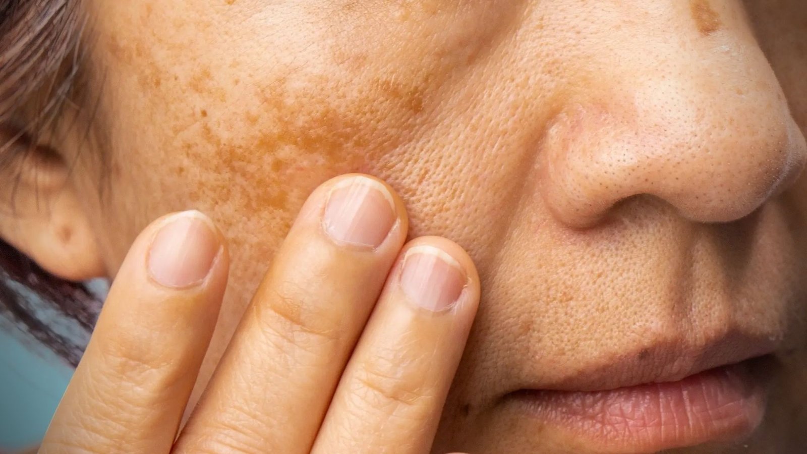Signs of Melasma