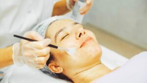 Chemical Peel Process