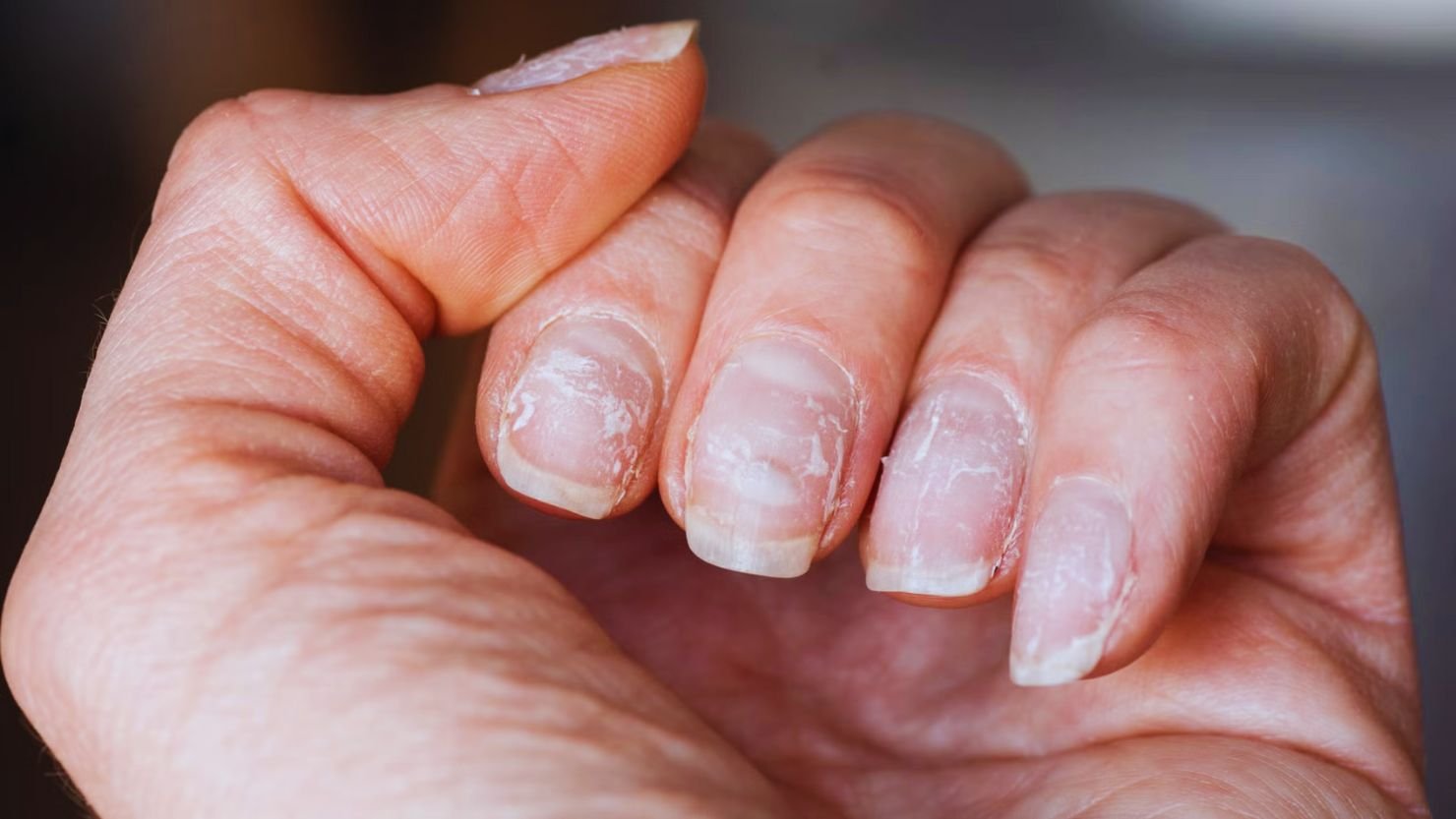 Understanding Fingernail Loss and Recovery