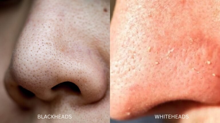 Blackheads vs Whiteheads