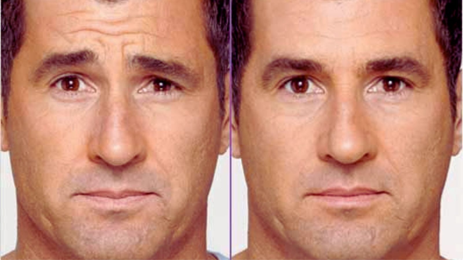 What Does 20 Units of Botox Mean