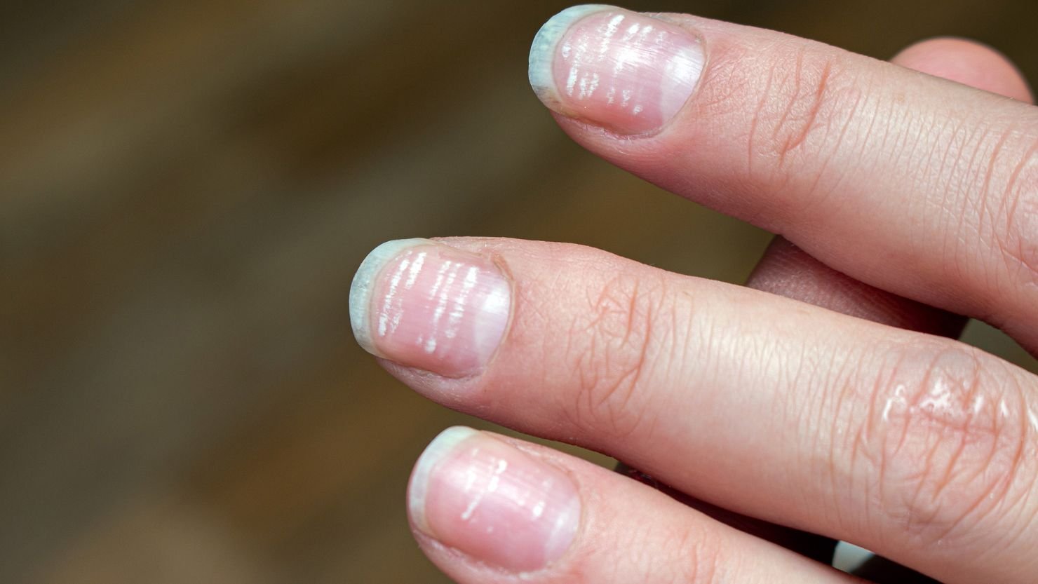 Nail Discoloration