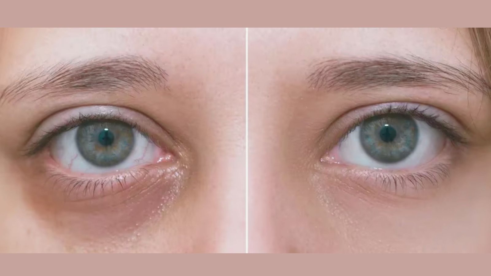 Eye Bags vs Dark Circles