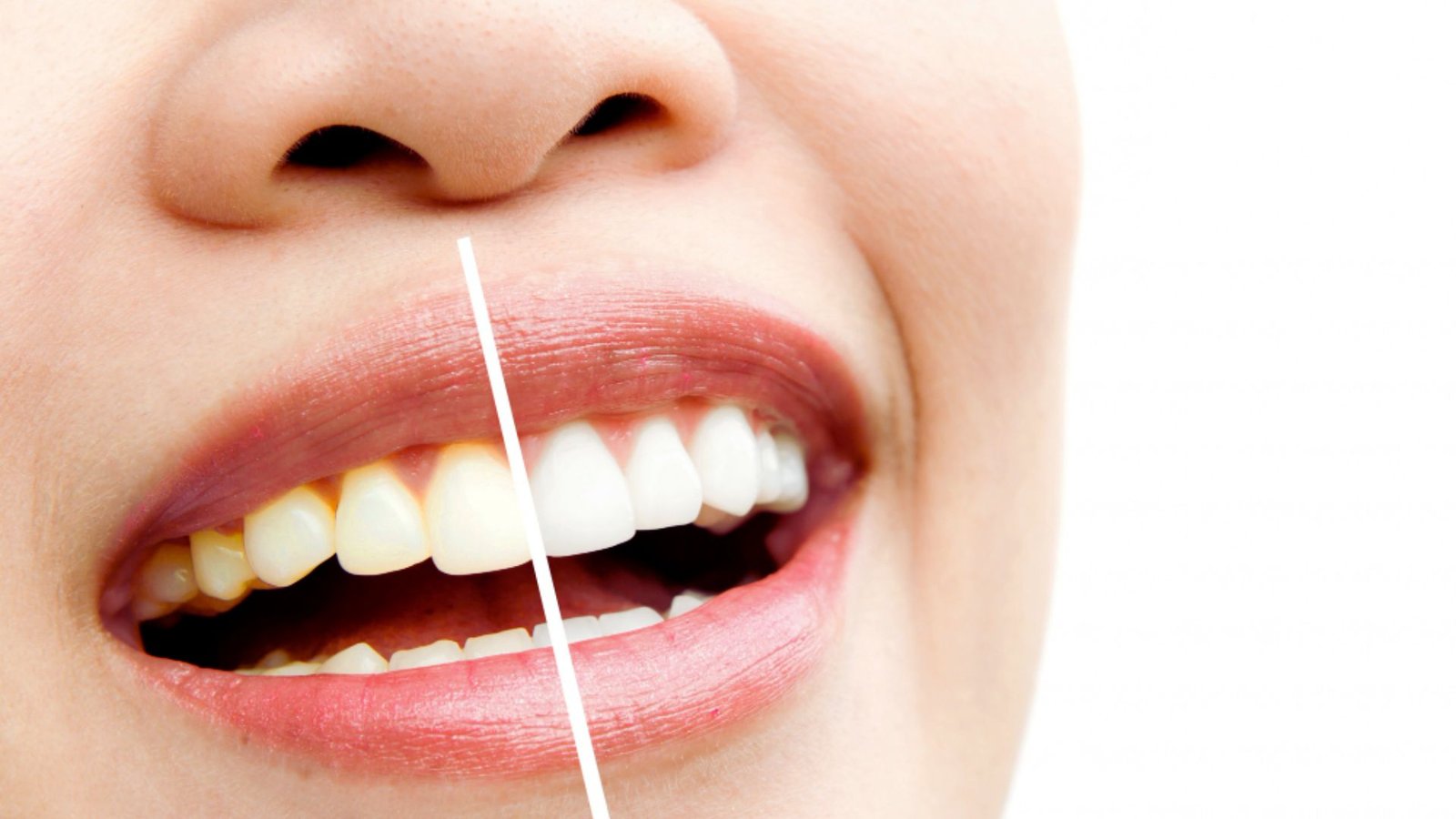 Are Whitening Strips Bad for Your Teeth