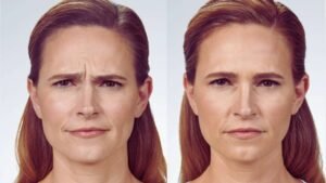 Units of Botox Before