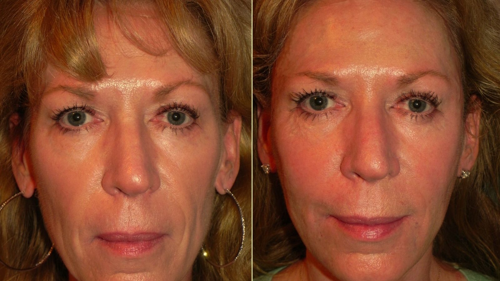 Common Sculptra Side Effects