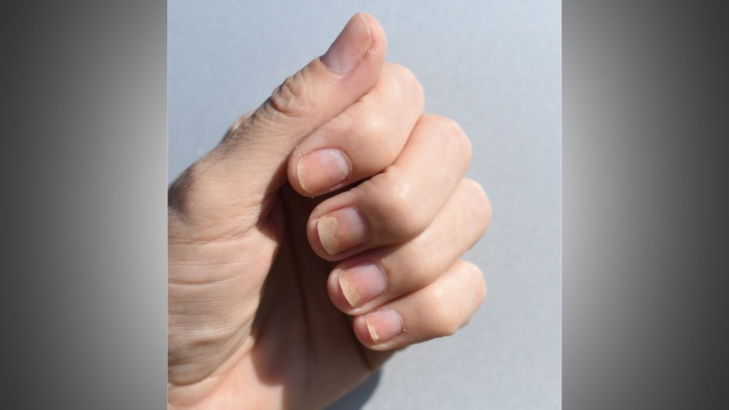 Nail Separation Begins