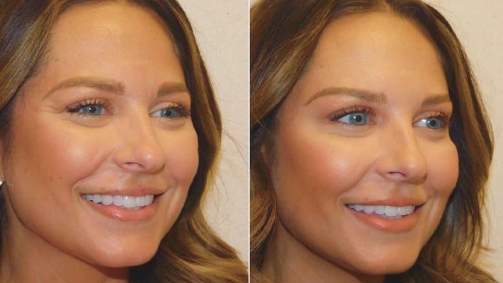 Key Differences Between Botox and Jeuveau