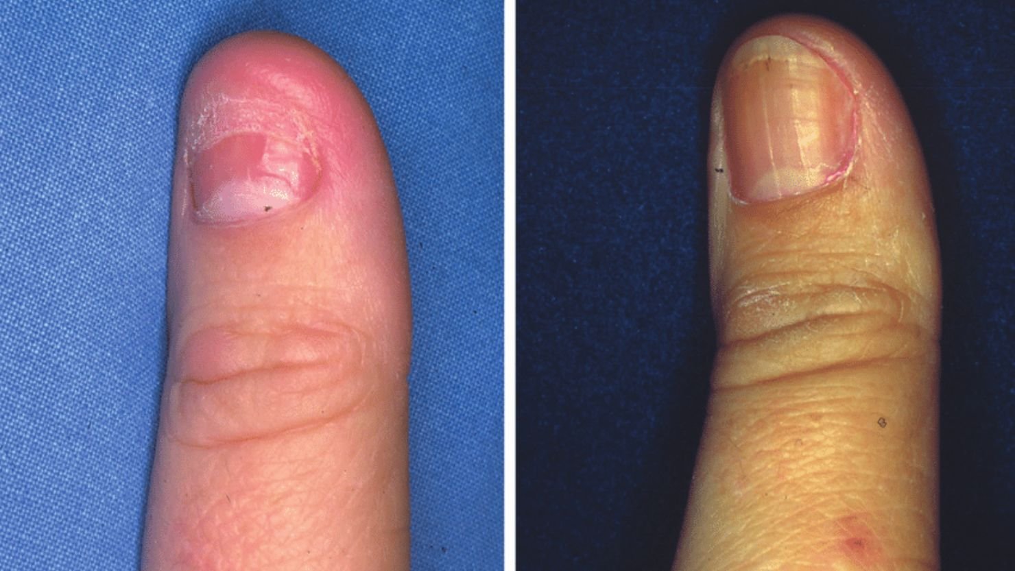 Nail Regrowth Process