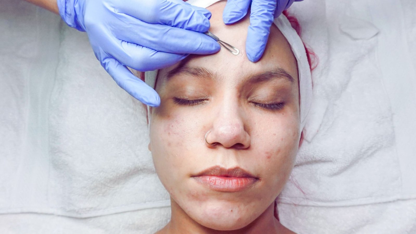 Acne Facial