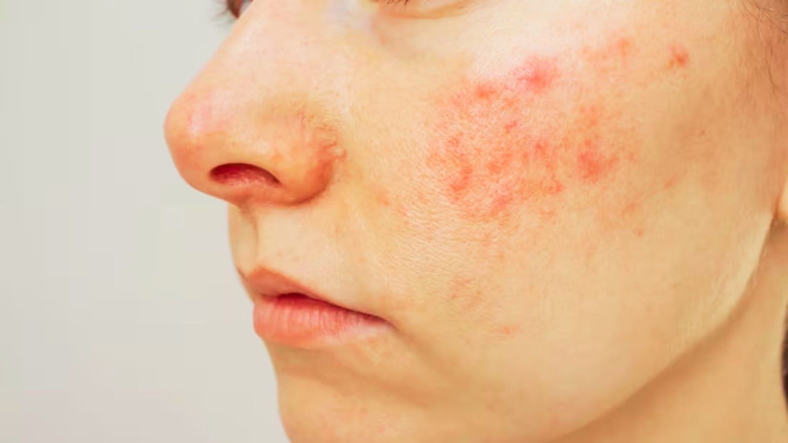 Treat Redness and Rosacea