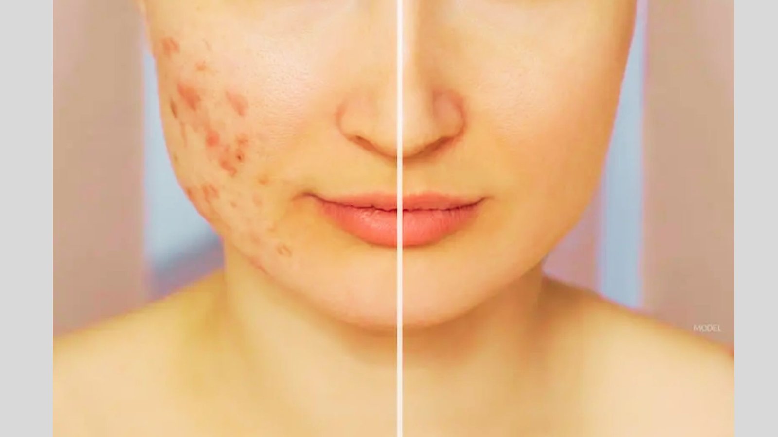 Reduce Acne Scars
