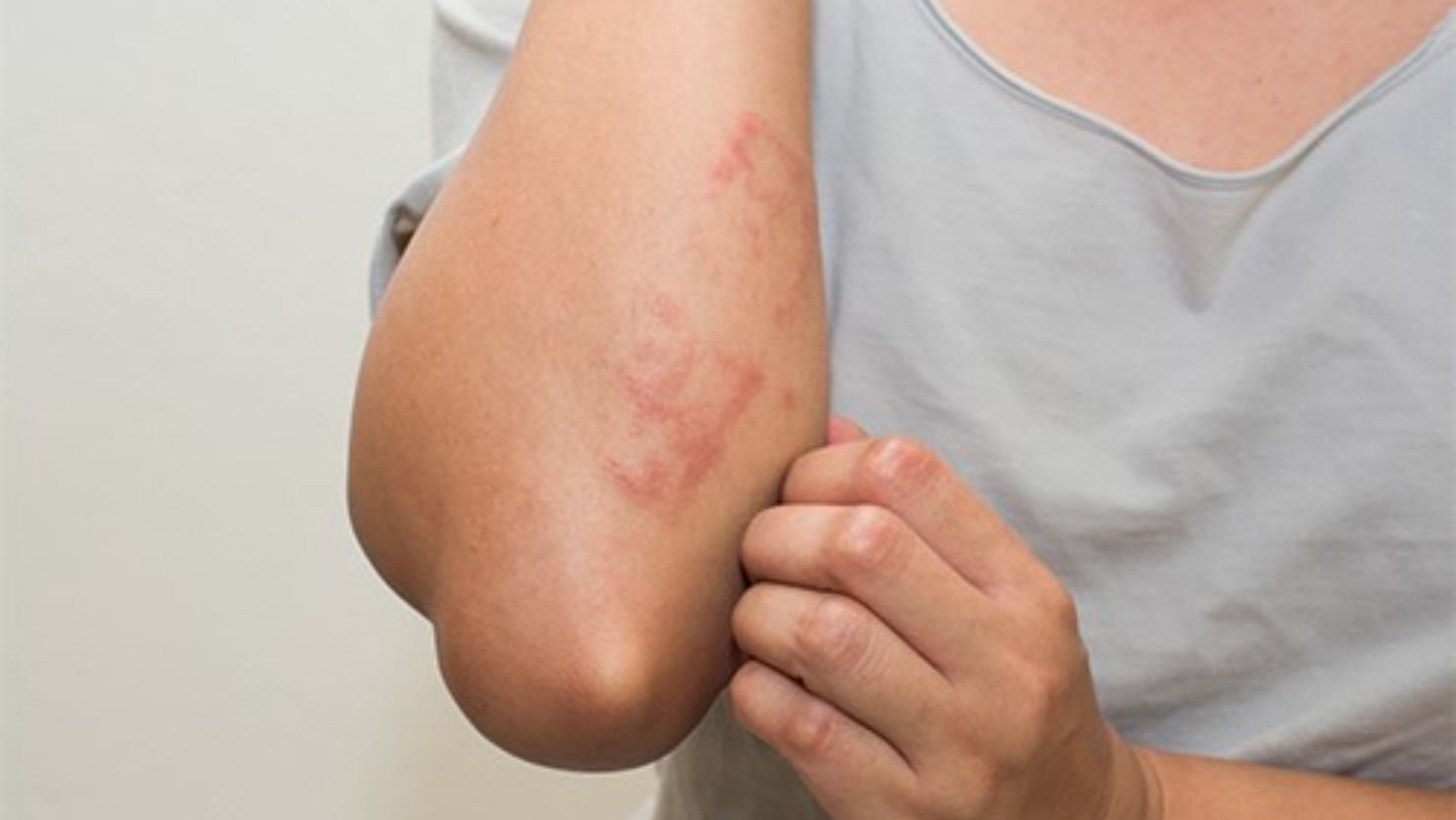 Skin Irritation and Allergic Reactions