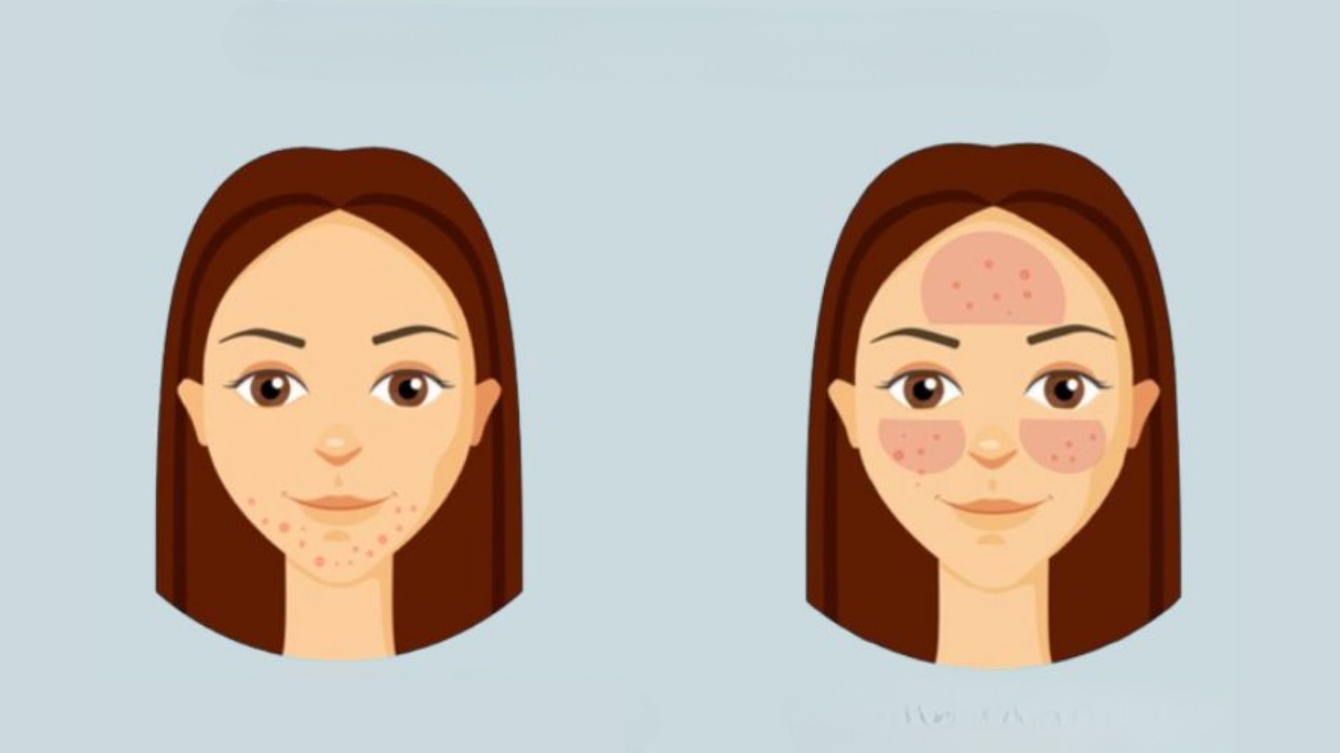 Rosacea vs Acne