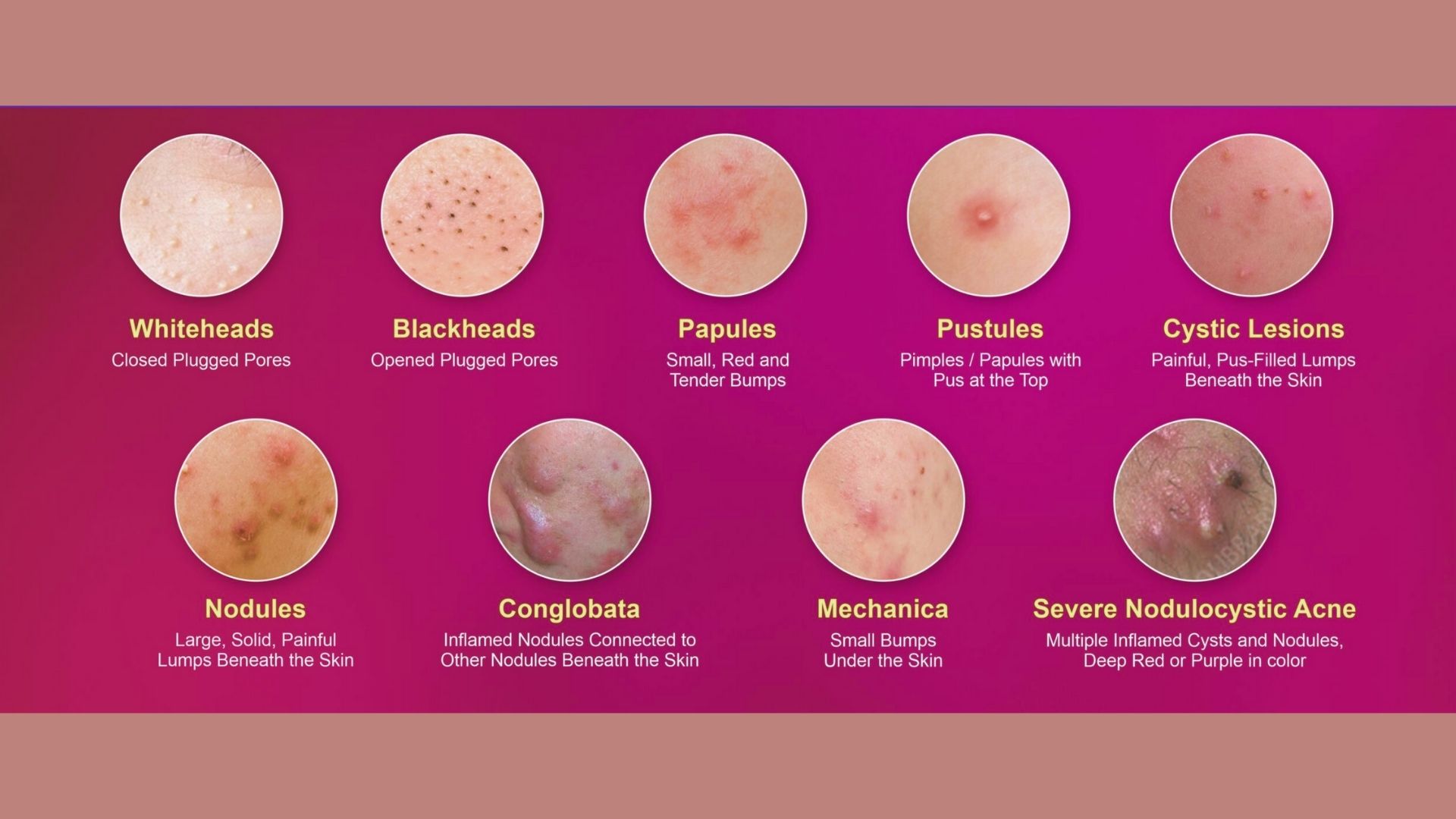 Types of Acne That Appear on the Forehead