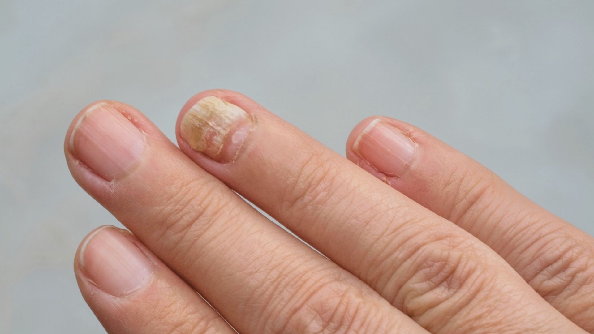 Common Cuticle Problems and Solutions