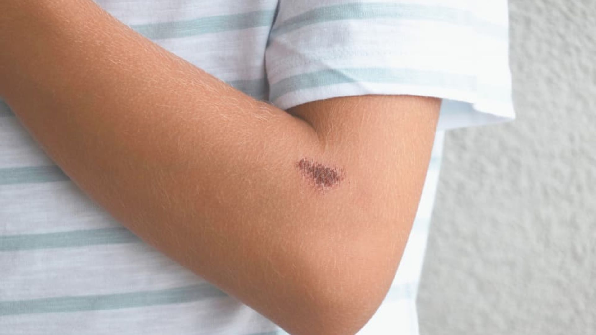 Stage 3: Remodeling Phase (Fading to Natural Skin Tone)