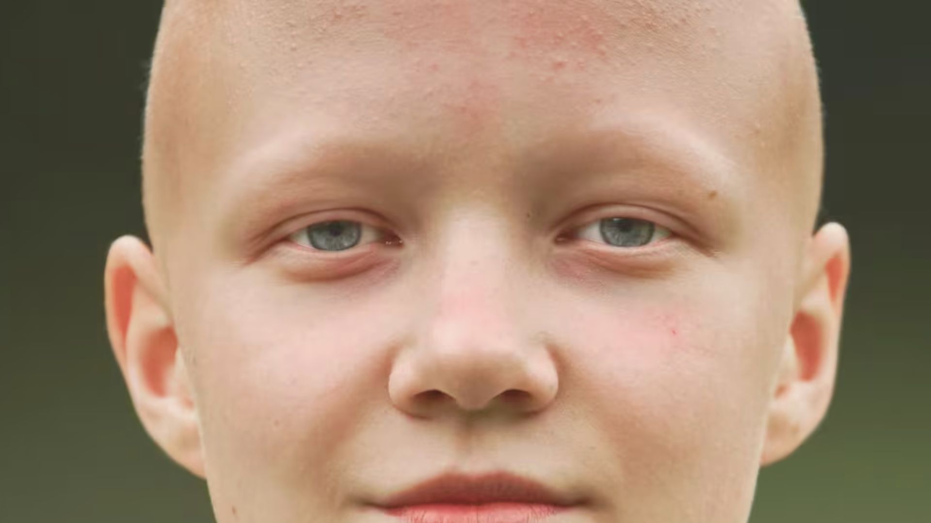 Why Does Alopecia Cause Eyelash Loss