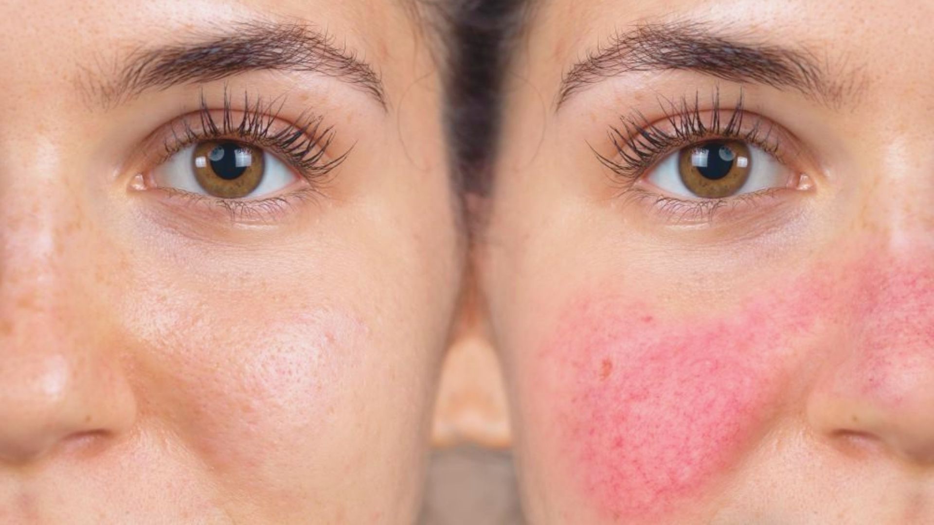 Can You Have Both Acne and Rosacea