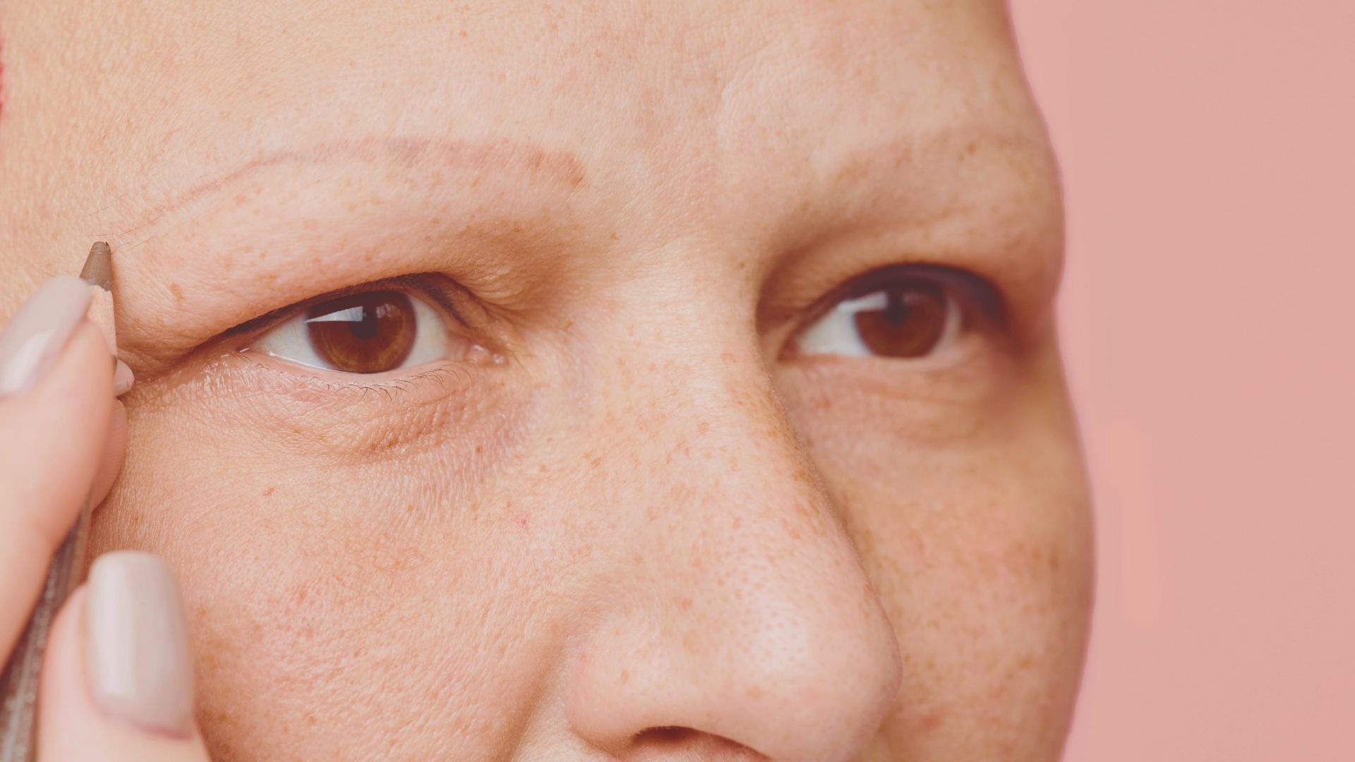 Do People With Alopecia