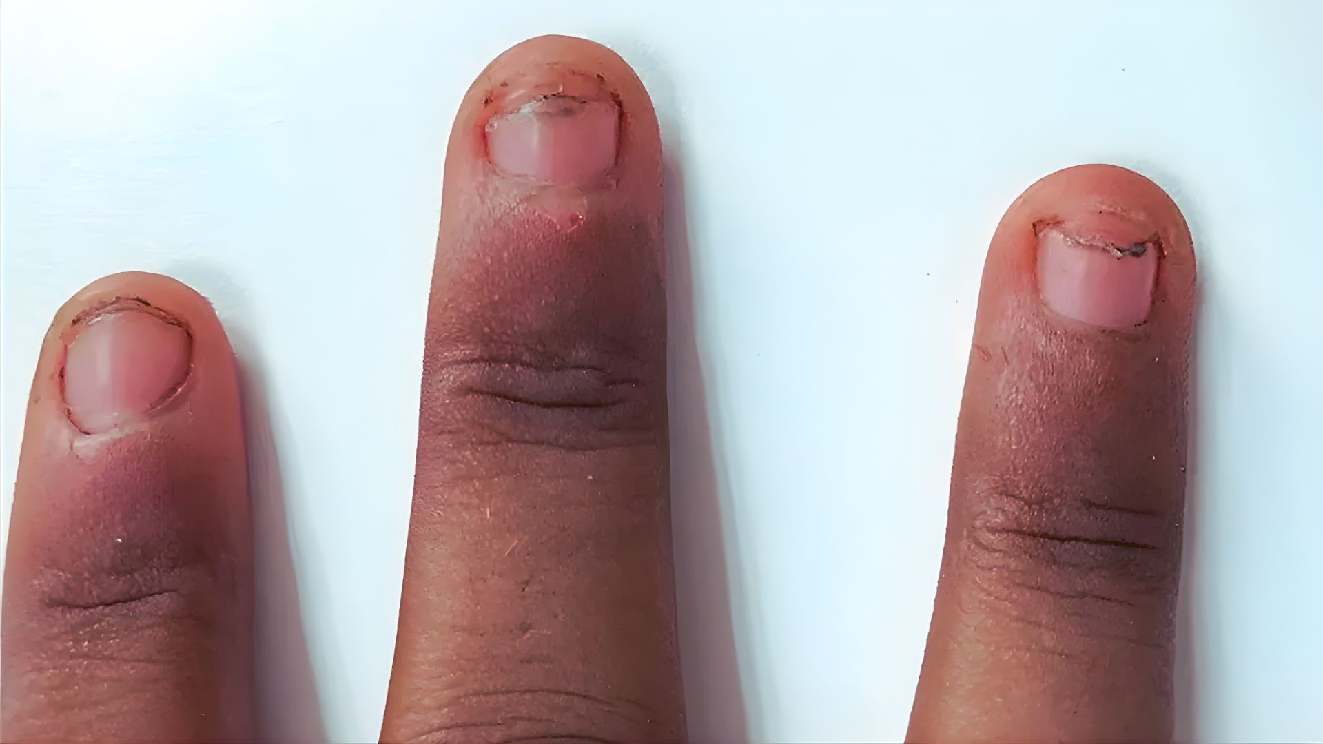 Nails Lifting From Nail Bed After Gel Nails: Causes & Care