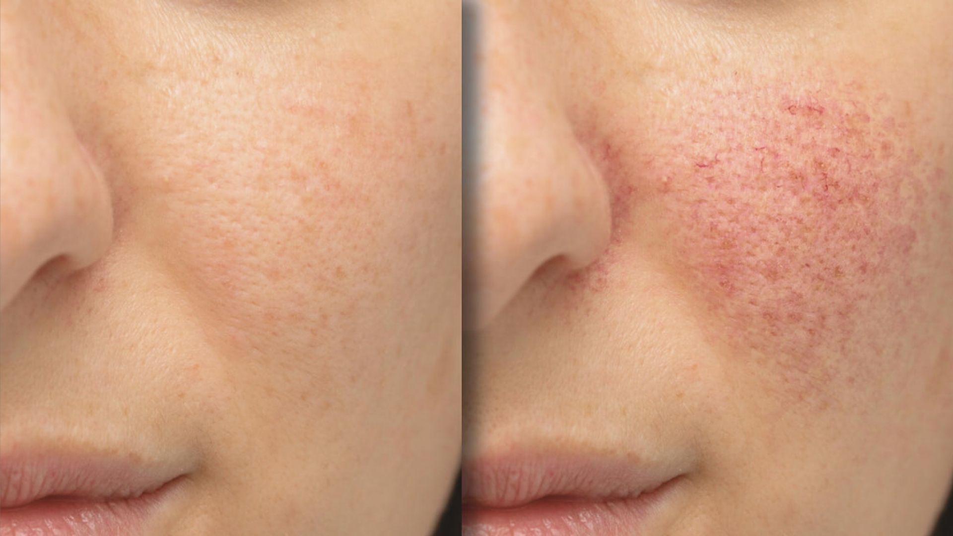 Rosacea vs Acne