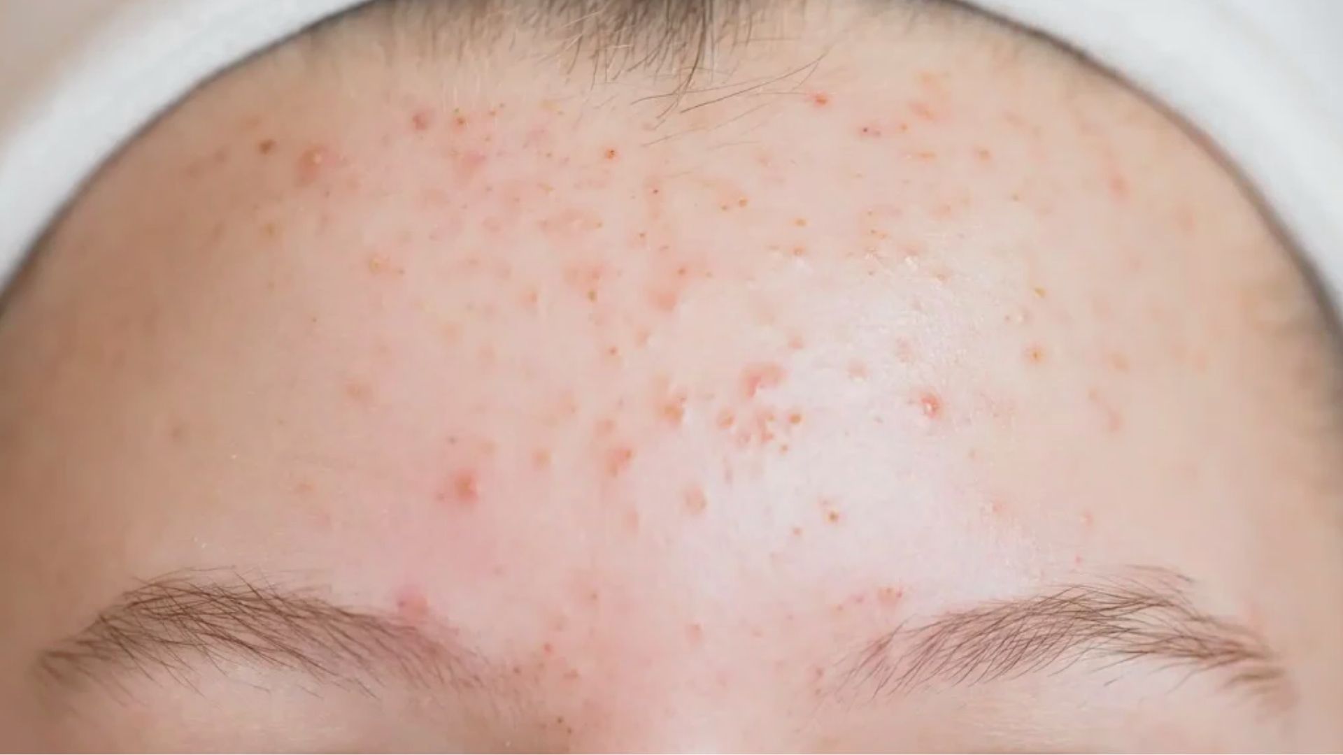 What Causes Forehead Breakouts