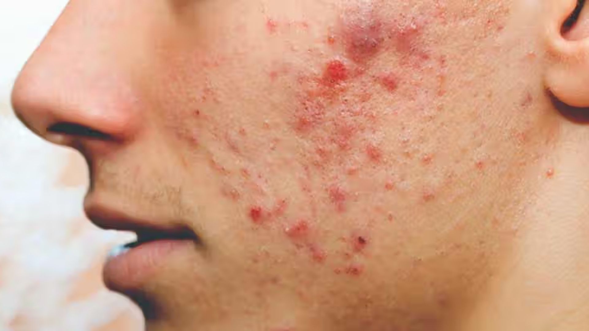 How to Identify a Pimple